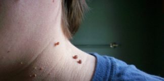 Remedii naturale pentru a scăpa de negi sau veruci