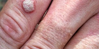 Metode de prevenire si tratamente naturiste la-ndemână contra negilor