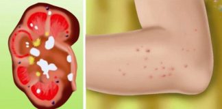 Dacă rinichii suferă, corpul prezintă aceste 8 semnale de alarmă