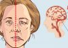 12 simptome ale accidentului vascular cerebral pe care toată lumea ar trebui să le cunoască