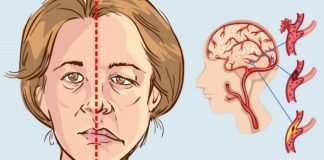 12 simptome ale accidentului vascular cerebral pe care toată lumea ar trebui să le cunoască