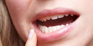 Sângerări gingivale – Cauze, remedii naturiste și alte sfaturi utile