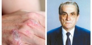 Reţeta de UNGUENT a vindecătorului Valeriu Popa, pentru PSORIAZIS