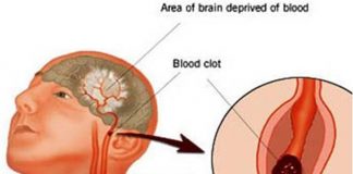 Poţi să ai un accident vascular cerebral şi tu să nici nu ştii