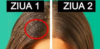 Cum scapi de mătreață – sfaturi și recomandări