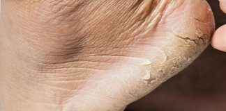 5 leacuri din bătrâni eficiente care tratează călcâiele crăpate și îngroșate. Iată cum sa scapi de fisurile si cheratinizarea pielii călcâielor