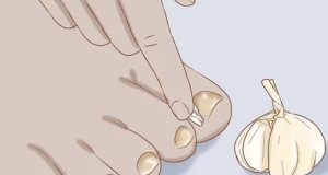 Cum să scapi de infecțiile fungice ale pielii – 9 remedii la îndemâna oricui