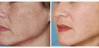 Scăpați de pete, pistrui și hiperpigmentare cu acest remediu natural