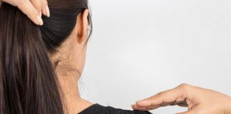 Ai mătreață? Folosește aceste două amestecuri simple și la îndemâna oricui