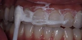 Cum scapi de tartru cu 3 alimente banale. Dentistii ti-au ascuns mereu asta!