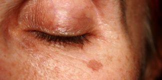 Cum se elimină acasă alunițele, negii, punctele negre, papiloamele și petele de vârstă
