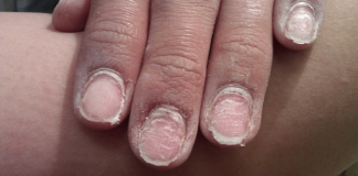 Manechiura cu gel – Consecințe îngrijorătoare