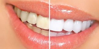 Cum să ai dinți albi și frumoși folosind produse din bucătărie