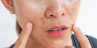 Îngrijirea zilnică a tenului gras. Vezi ce trebuie să faci