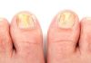 Onicomicoza sau „ciuperca unghiei”: simptome și tratament