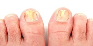 Onicomicoza sau „ciuperca unghiei”: simptome și tratament