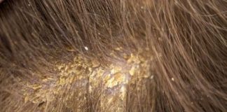 Dermatita seboreica: cauze, simptome și cum se tratează acasă
