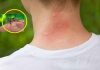 Muşcăturile de ţânţari – prevenire şi remedii naturale