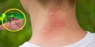 Muşcăturile de ţânţari – prevenire şi remedii naturale