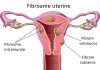 Tratament naturist pentru Fibrom Uterin