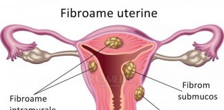 Tratament naturist pentru Fibrom Uterin