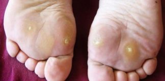 Cum poți să scapi de bătături fără să mergi la medic! Iată cele mai bune remedii și tratamente!