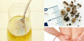 Cum eliminăm în mod natural nisipul și pietrele de la rinichi!