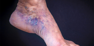 Cu aceste 8 simptome putem recunoaște la timp TROMBOZA la nivelul picioarelor!