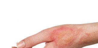 M-am opărit cu apă clocotită. Am aflat 10 remedii utile în caz de arsuri cu apă fiartă!