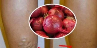 Ceapa roşie topeşte varicele! Iată cum se prepară remediul-minune şi ce obiceiuri le cauzează.