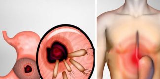 Scapă de bacteria care cauzează arsuri la stomac, ulcer și balonare în doar câteva ore!