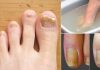 Scapă în mod natural de ciuperca unghiilor, calusuri, bătături și chiar gută. Scufundați-vă picioarele în această apă!
