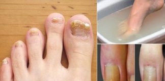 Scapă în mod natural de ciuperca unghiilor, calusuri, bătături și chiar gută. Scufundați-vă picioarele în această apă!