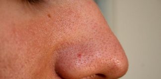 Iată cum să scapi de cearcăne, coșuri, puncte negre și herpes prin metodele bunicii