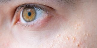Punctele albe sau de grăsime de pe față – de ce apar și cum scăpăm de ele!