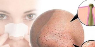 Scapă de punctele negre și albe de pe față în cel mai ușor mod cu putință, de acasă!