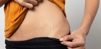 Tratamente naturale împotriva vergeturilor – Simple și eficiente!