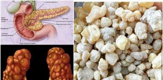 Tămâia distruge celulele canceroase de la nivelul ovarelor și topește chisturile de pe ficat, plămâni sau rinichi