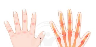 Aveți mâinile afectate de artrită? Iată 6 rețete naturiste pentru durerile cauzate de artrită!