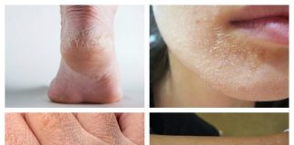 Bolile de ficat și de tiroidă se pot vedea pe piele! Cum putem observa dacă avem astfel de probleme?